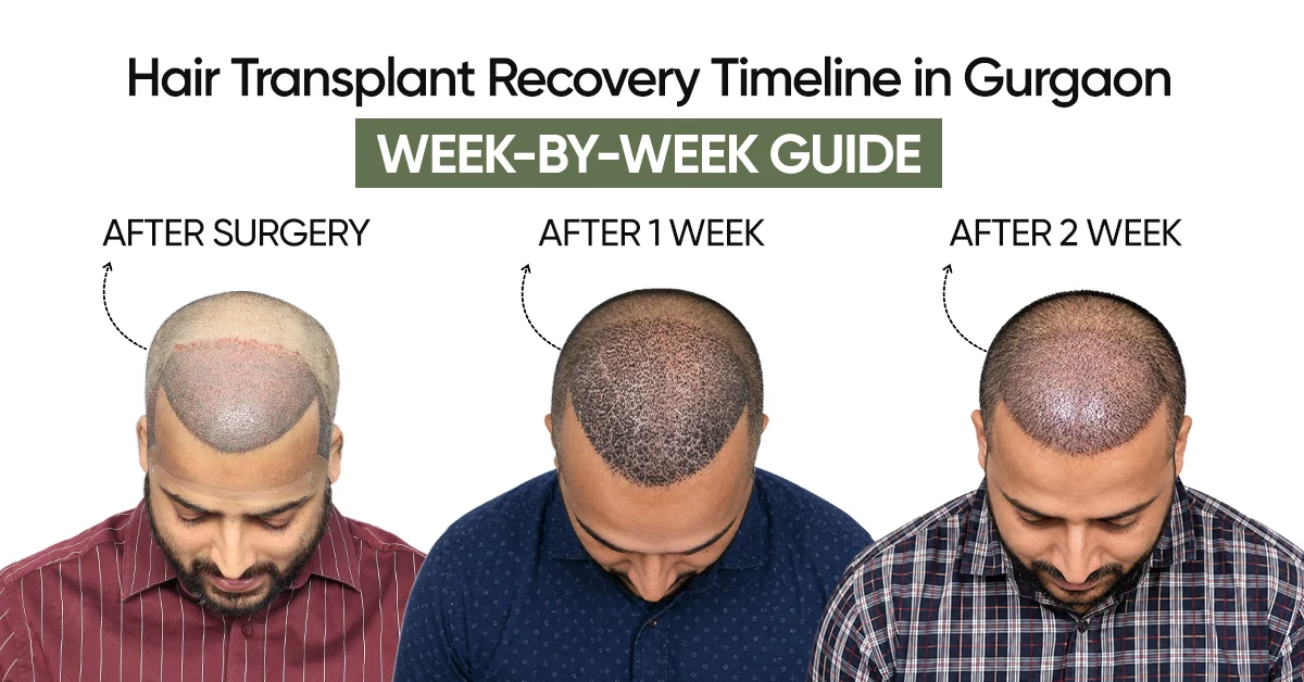 Hair Transplant Recovery Timeline in Gurgaon