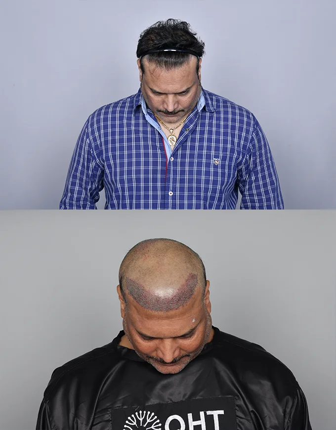 Before & After Gallery | QHT Gurgaon Hair Transplant Patients