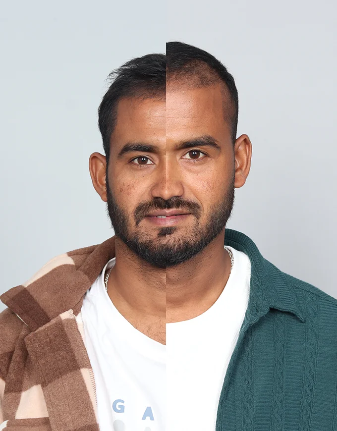 Month-by-Month Hair Growth Timeline After Transplant
