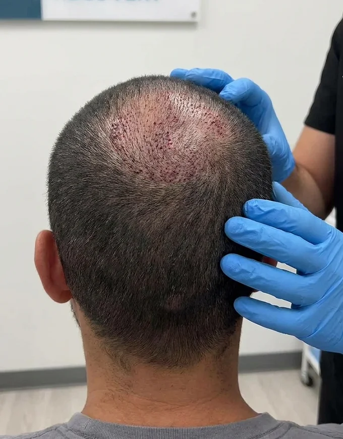 Crown vs Frontal Hairline Results at QHT