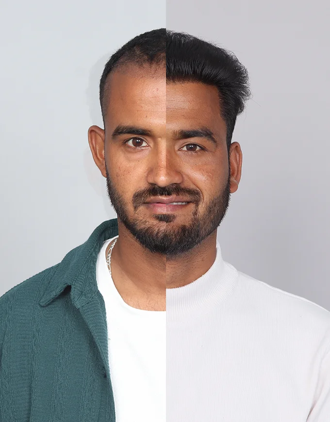 FUE Results – Side-by-Side Comparisons