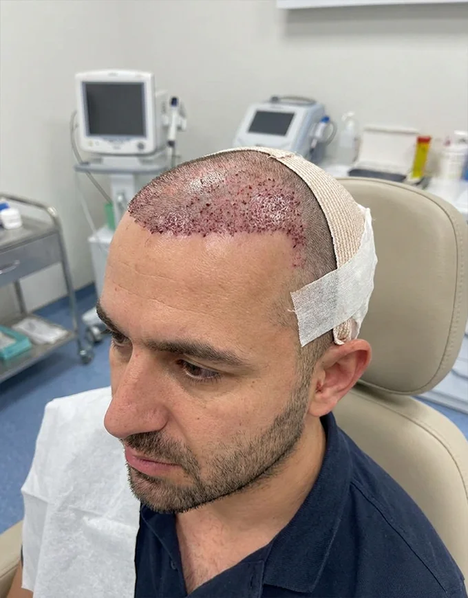 Surgeon's Approach to Hairline Design & Graft Placement